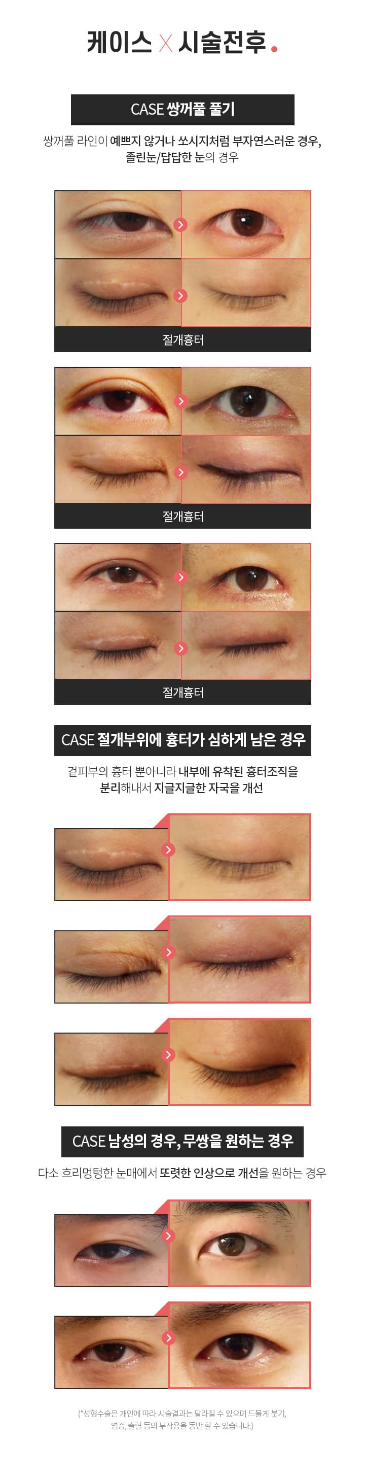 쌍꺼풀 풀기 시술전후