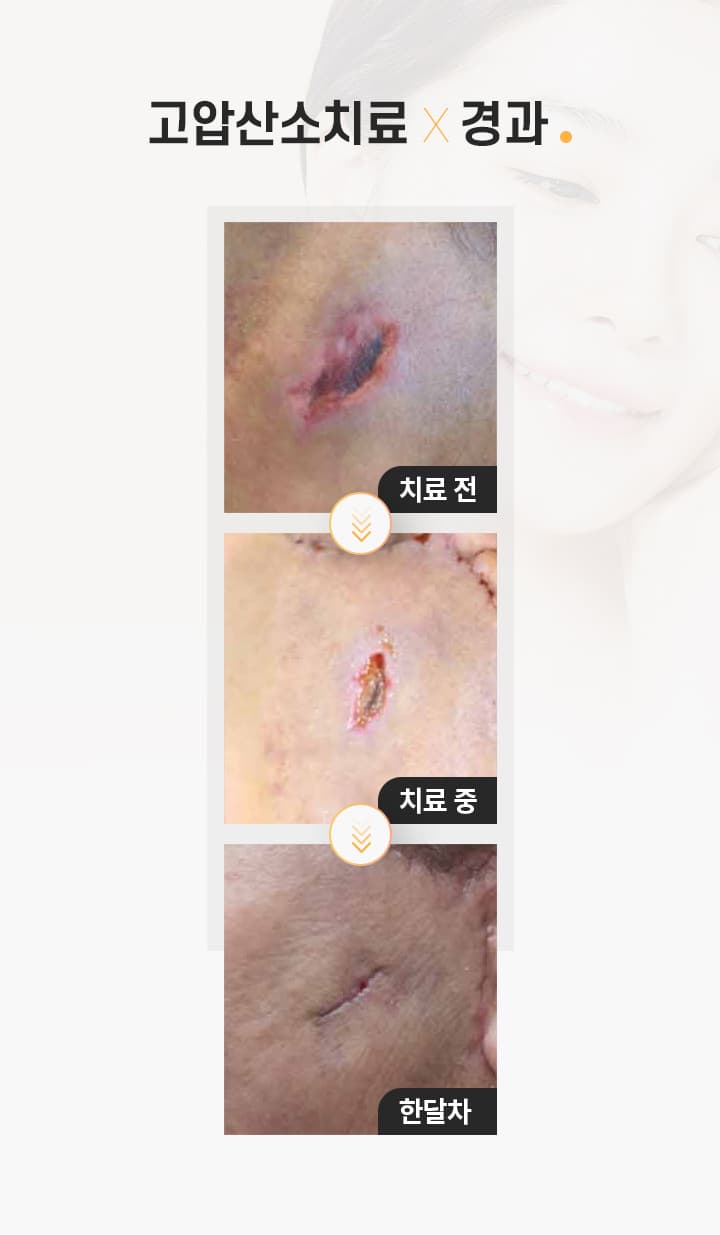 고압산소치료 진행 과정