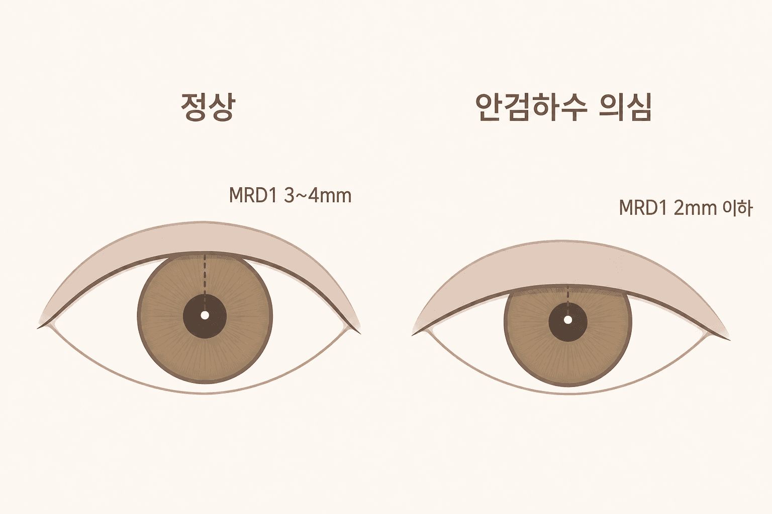 안검하수 자가진단 MRD1 도해 — 정상 눈은 동공 반사점에서 윗눈꺼풀까지 3~4mm, 안검하수 의심 눈은 눈꺼풀이 검은자를 덮어 2mm 이하로 줄어든 모습 비교