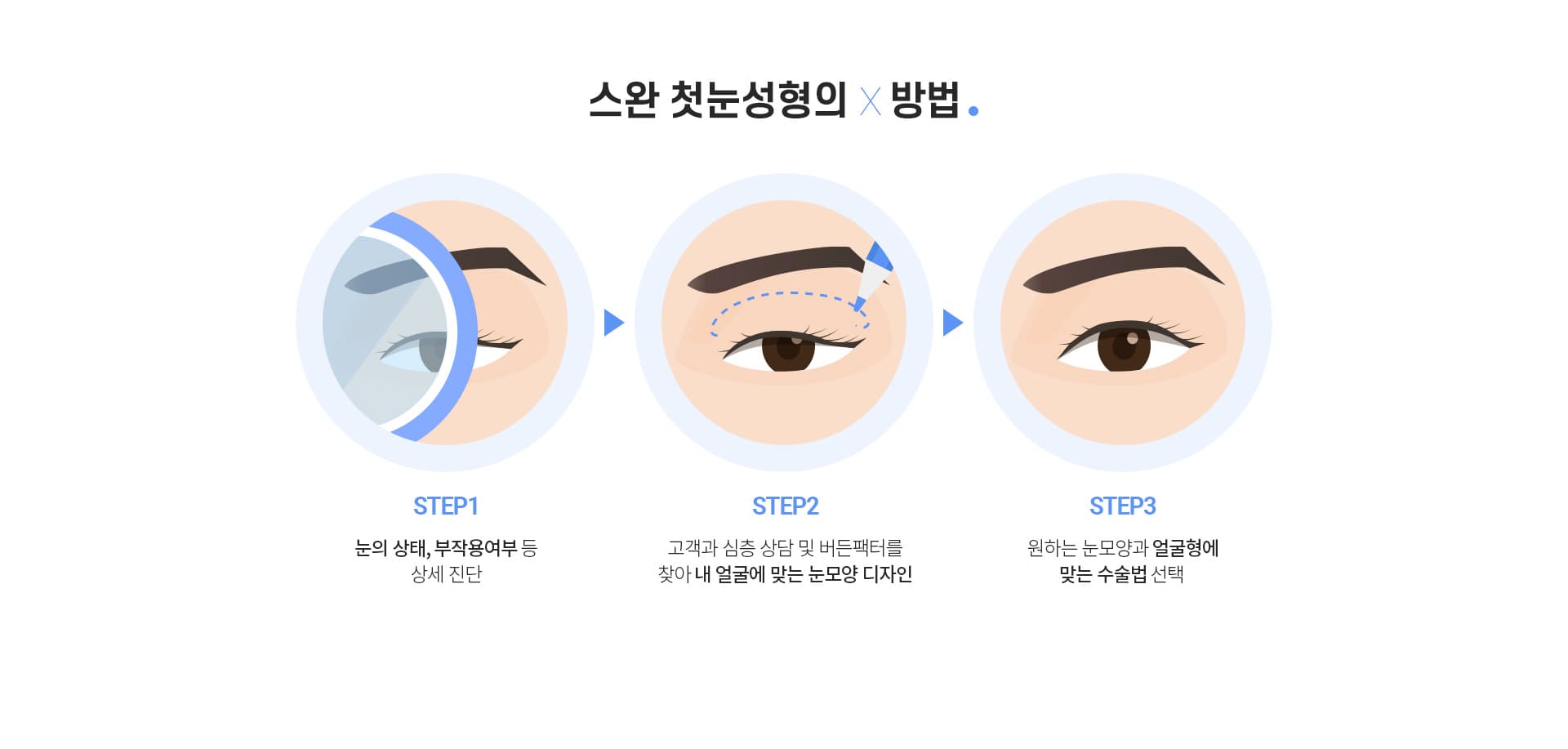 스완 첫눈성형의 방법