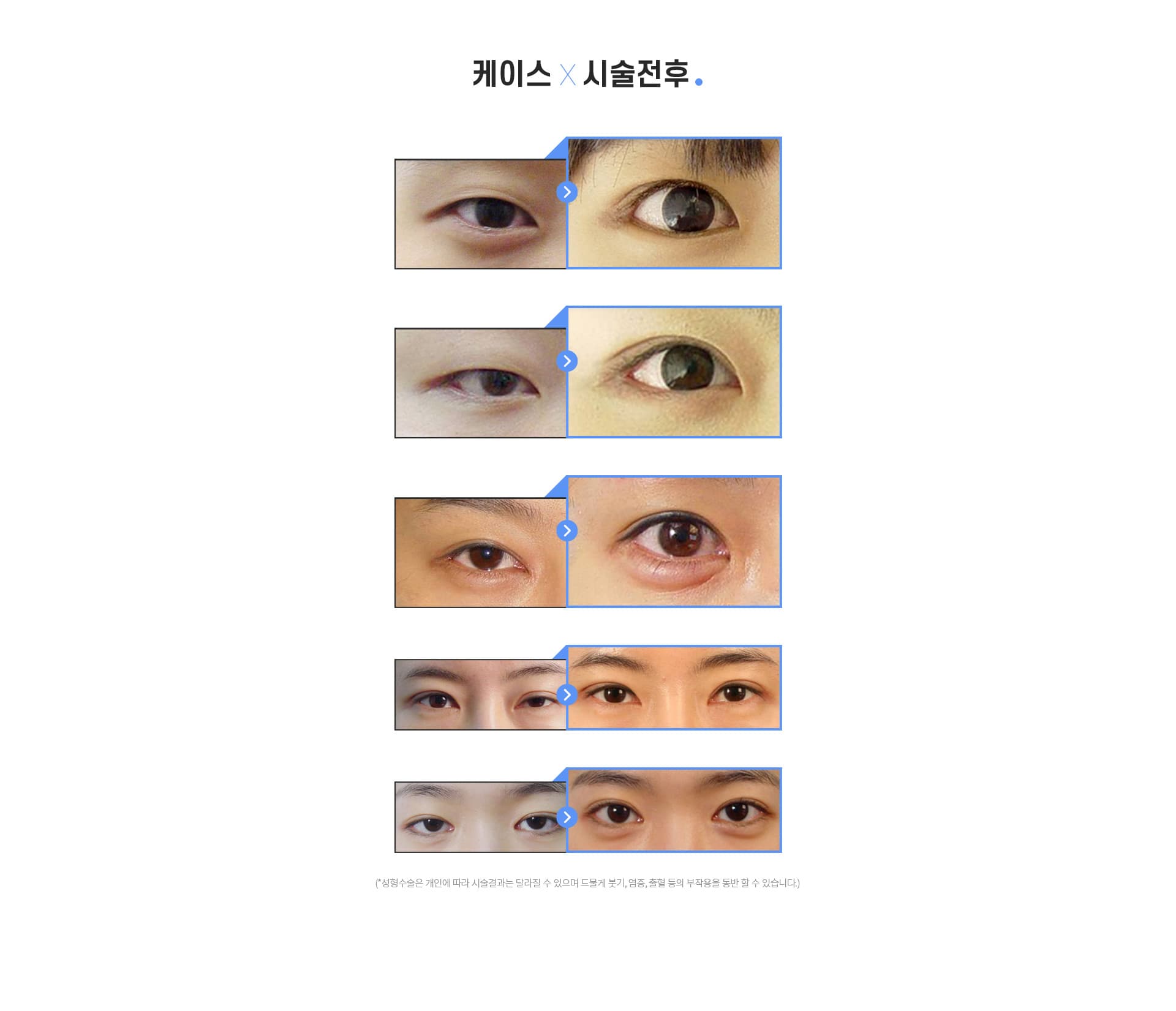 스완 케이스시술전후
