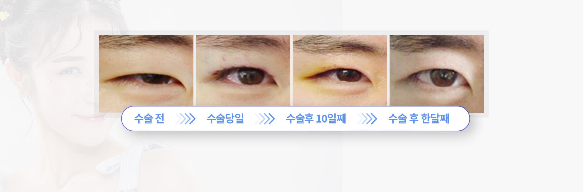 안검하수 수술 경과