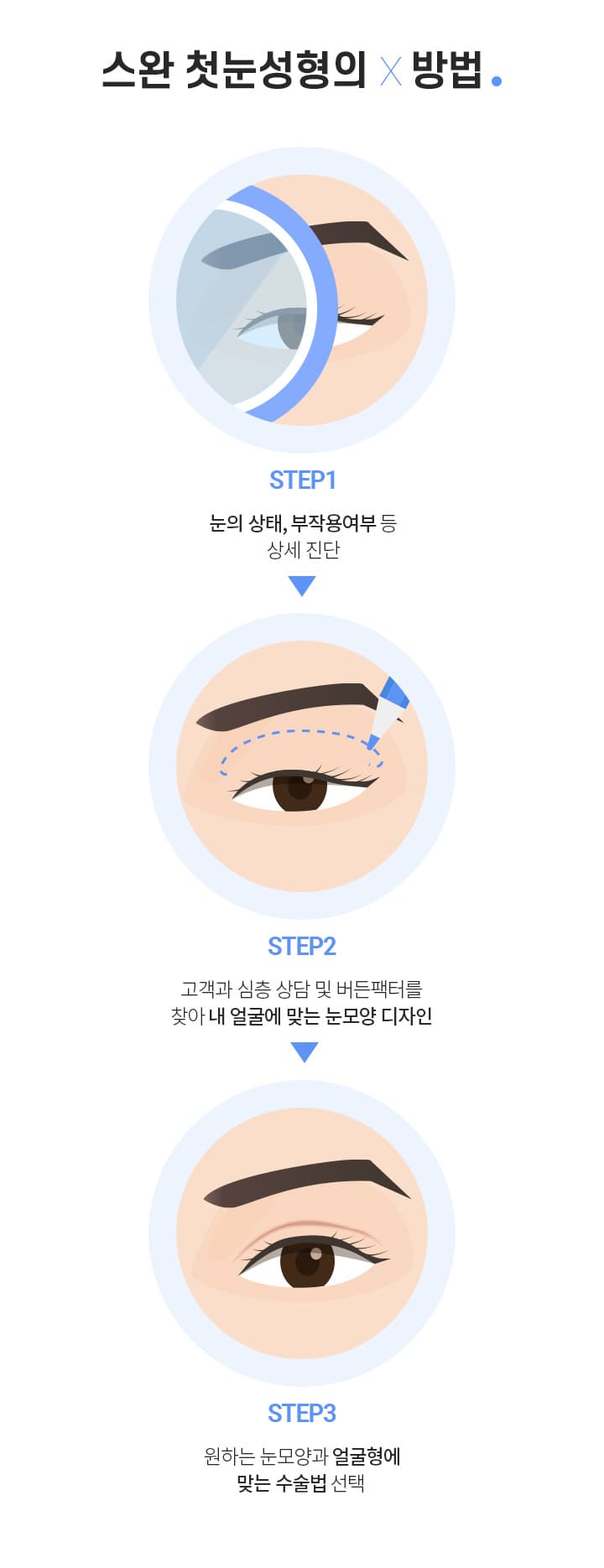 스완 첫눈성형의 방법