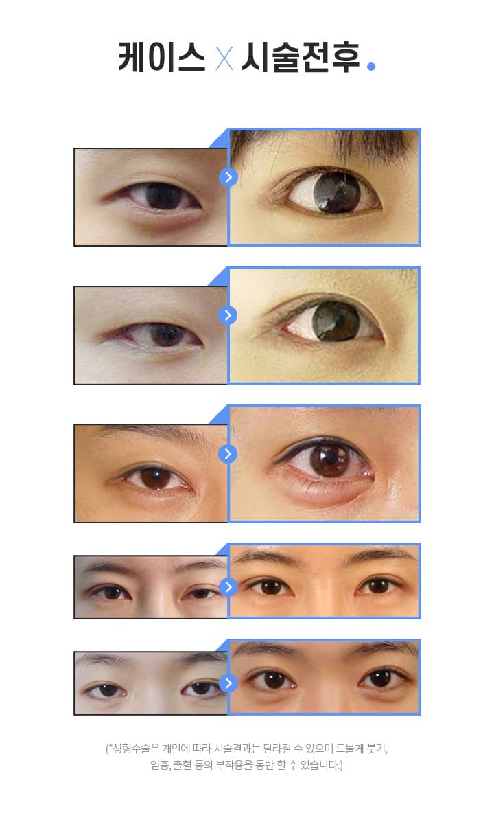 스완 케이스시술전후