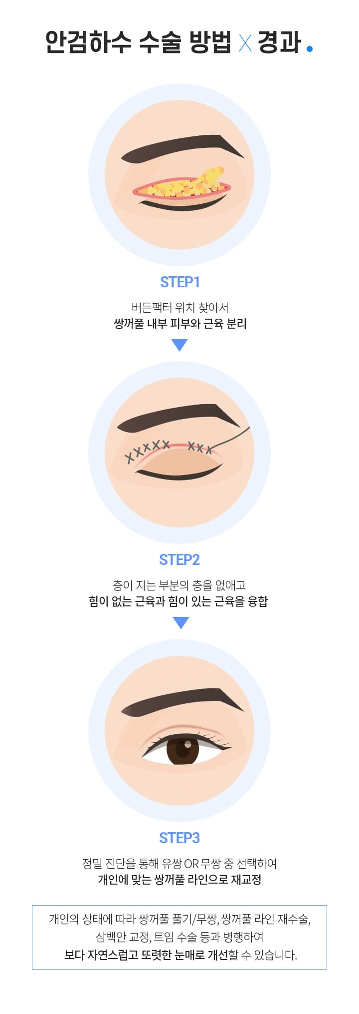 안검하수 수술 방법