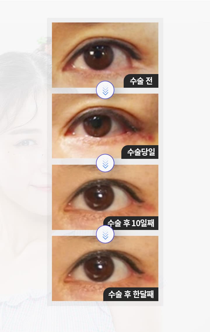 안검하수 수술 경과