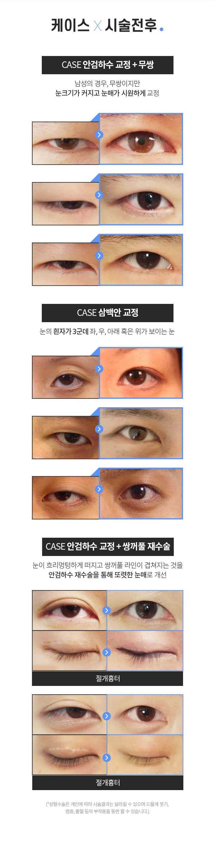 안검하수 시술전후