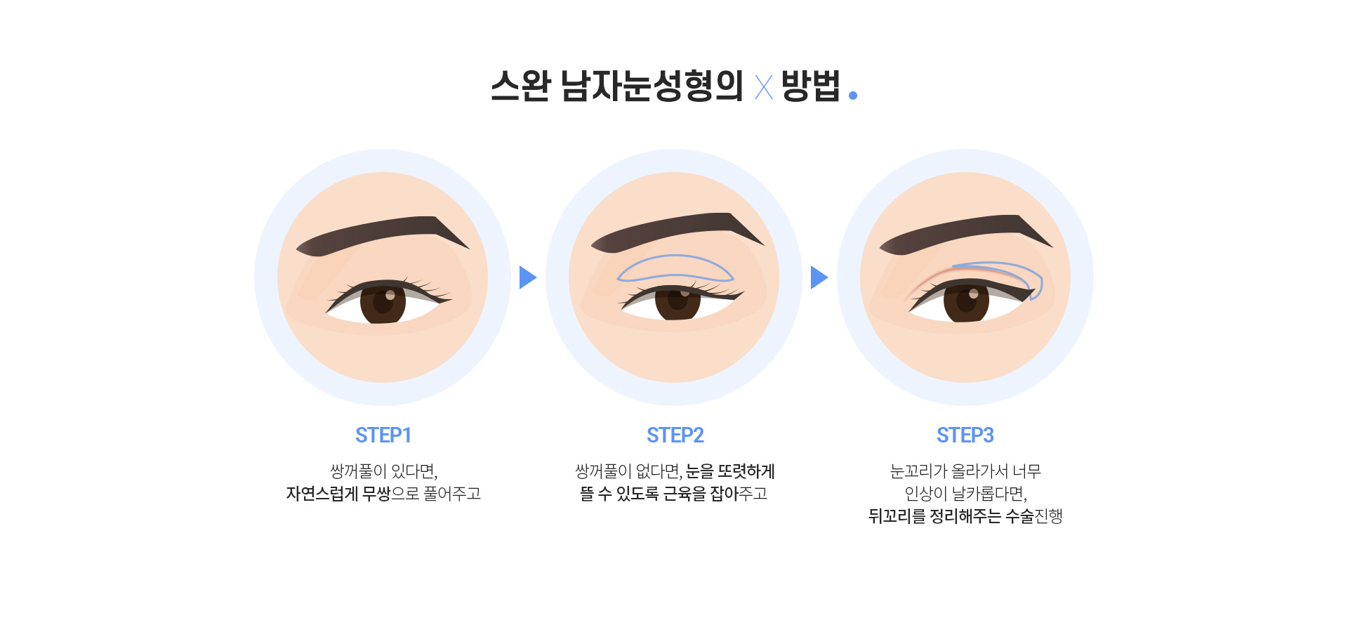 스완 남자눈성형의 방법 