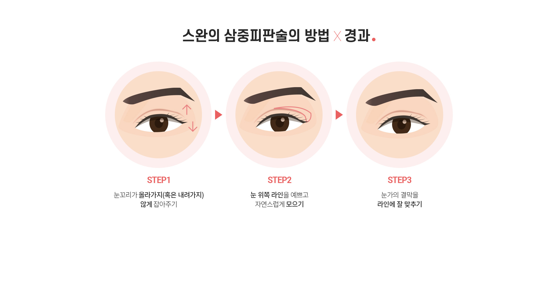 스완 삼중피판술의 방법 