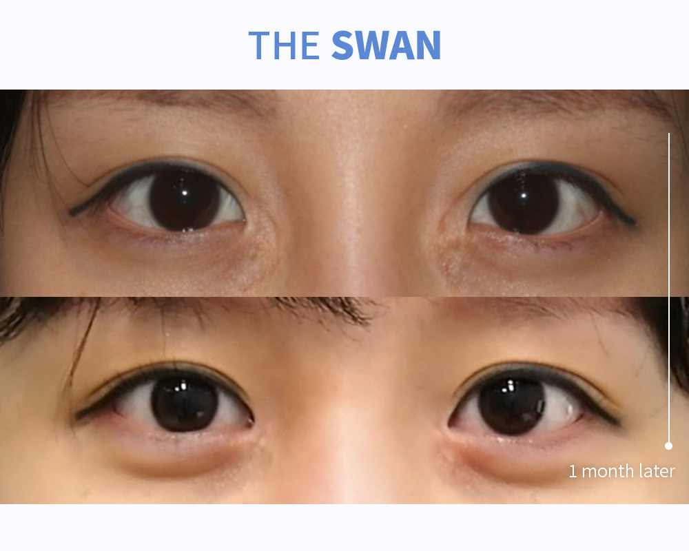 앞트임 재수술