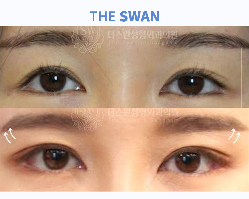 포니테일수술